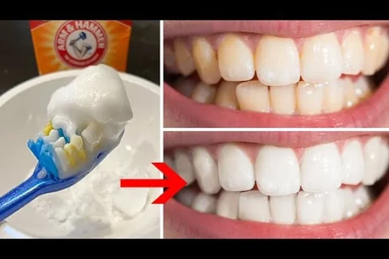 Baking Soda Teeth Whitening Guide for a Brighter Smile
